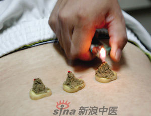 灸法的種類  你知道多少？
